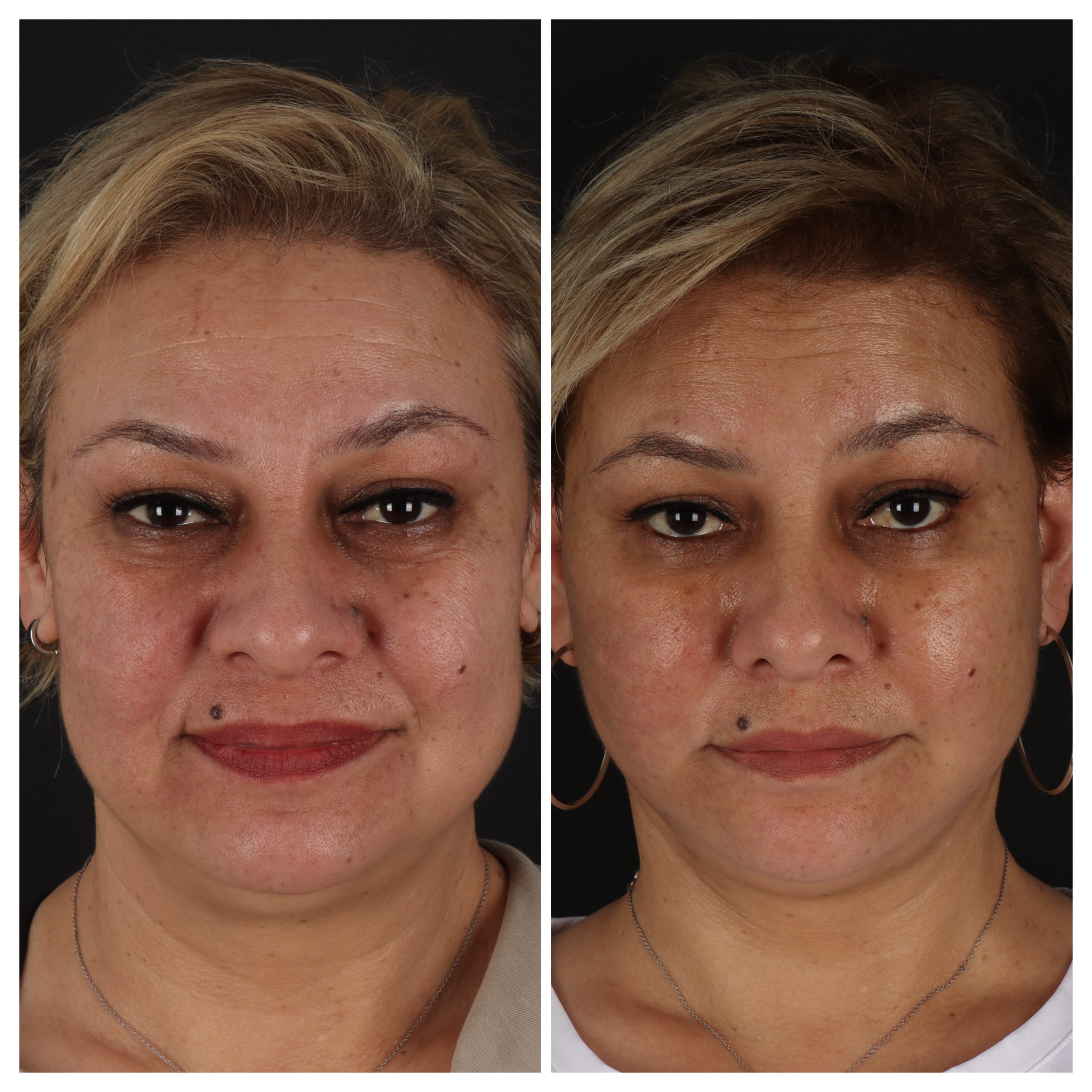 Before After